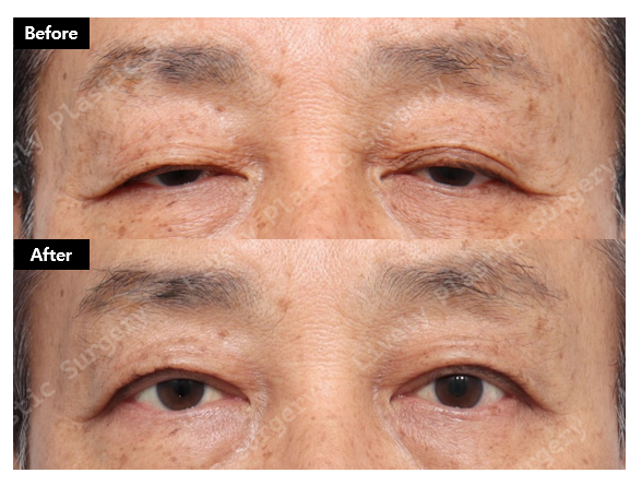 안검하수 교정전후